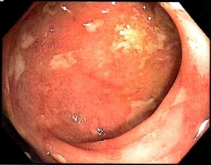 The white areas are ulcers (image is from author's husband's colonoscopy).