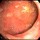 Ulcerative Colitis:  An (Often Misunderstood) Autoimmune Disease
